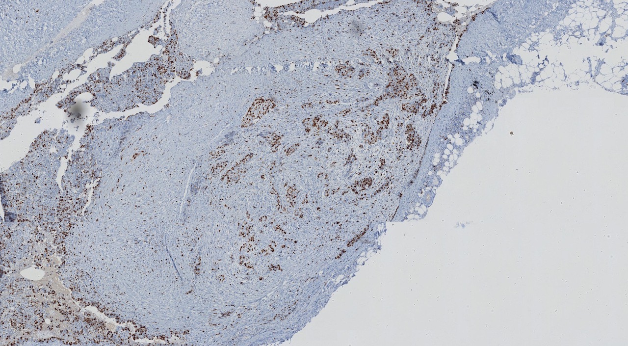 mesotelioma