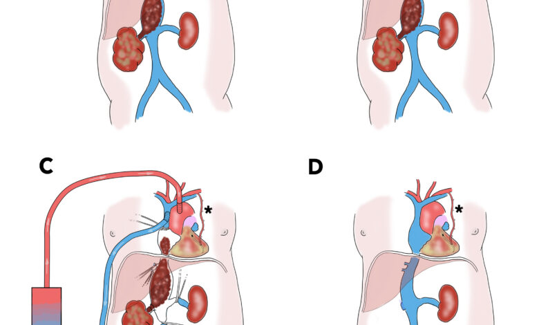 Eccezionale intervento